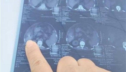 癌症病人做手术针头落体内，院方：建议不取，赔偿在协商中