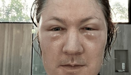 曾尝试换血减龄的美亿万富翁自曝整脸翻车：脸肿到眼睛看不见，下次继续