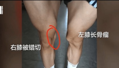 17岁体育生左膝长骨瘤却被错切右膝！母亲：拒绝和解
