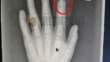 小鹏汽车回应“X9屏幕夹断5岁男童半节食指”
